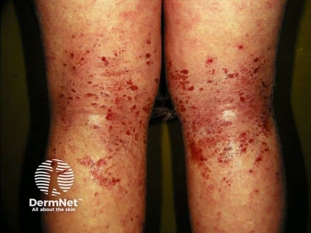 Atopic dermatitis