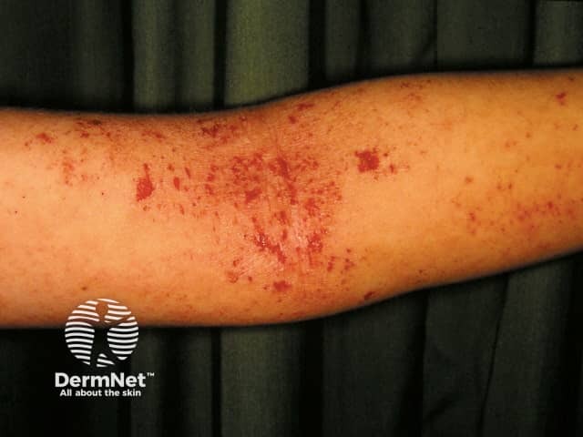 Atopic dermatitis