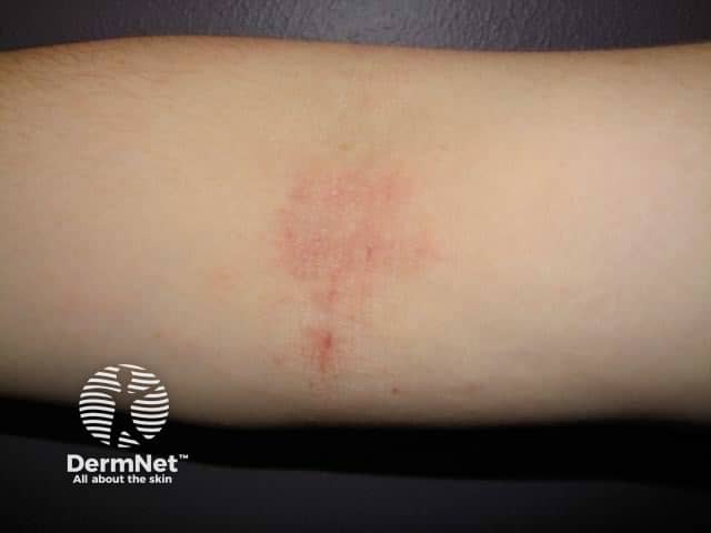 Atopic dermatitis