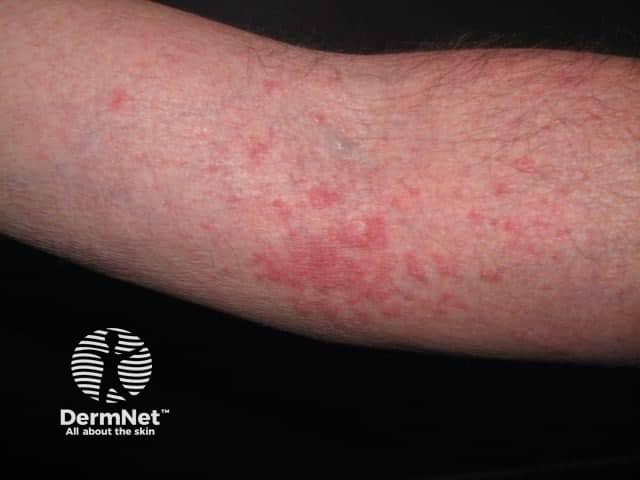 Atopic dermatitis