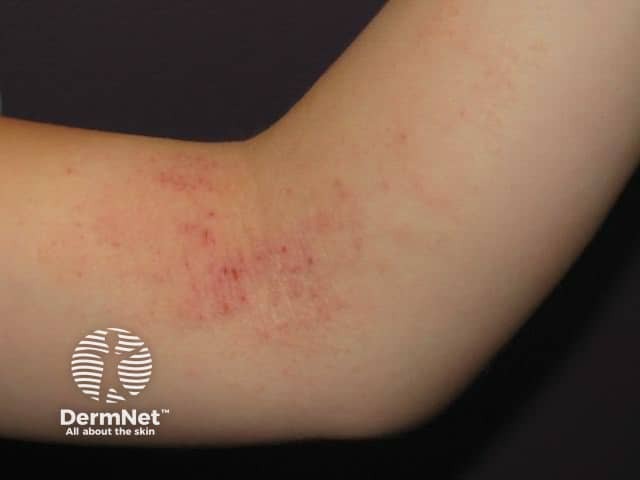 Flexural atopic dermatitis in childhood