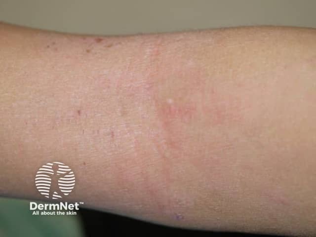 Atopic dermatitis