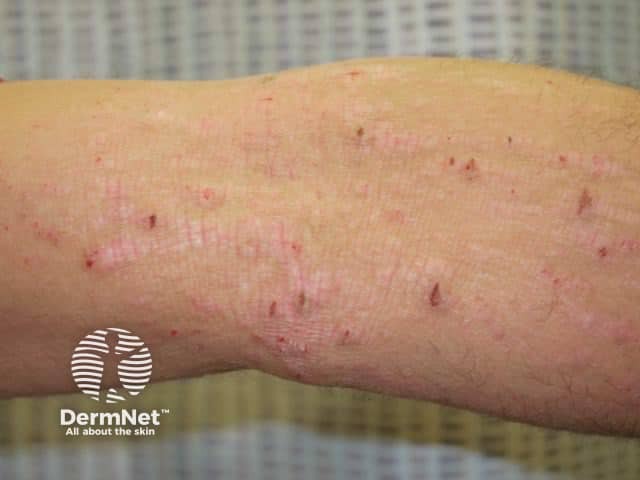 Atopic dermatitis