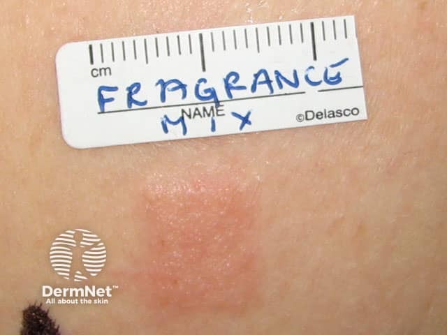 Positive patch test to fragrance