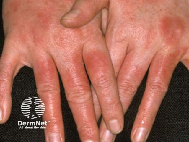 Hand dermatitis