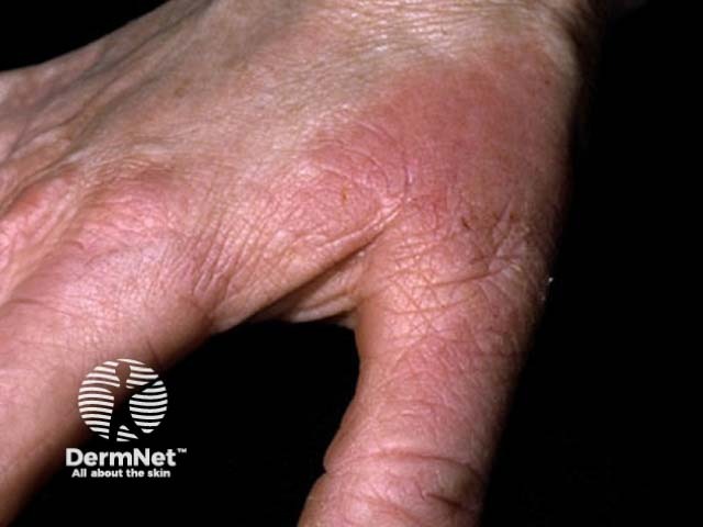 Hand dermatitis