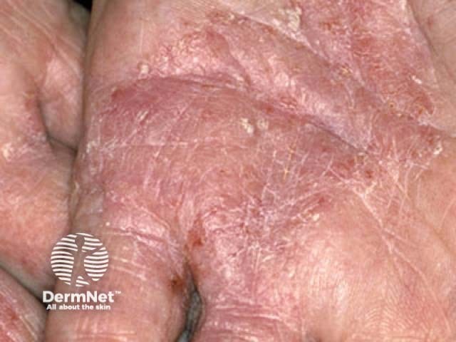 Hand dermatitis