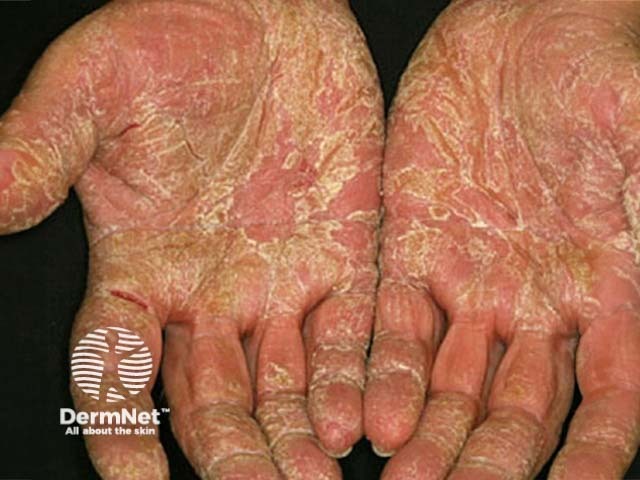 Hand dermatitis