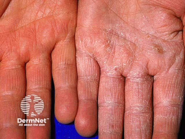 Hand dermatitis