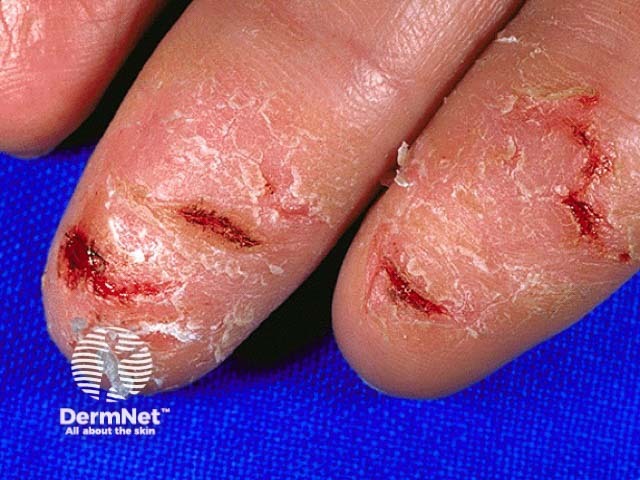 Hand dermatitis