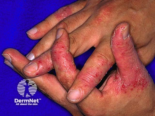 Hand dermatitis