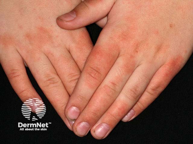 Hand dermatitis