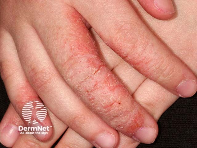 Hand dermatitis