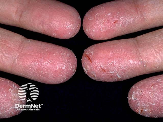 Hand dermatitis