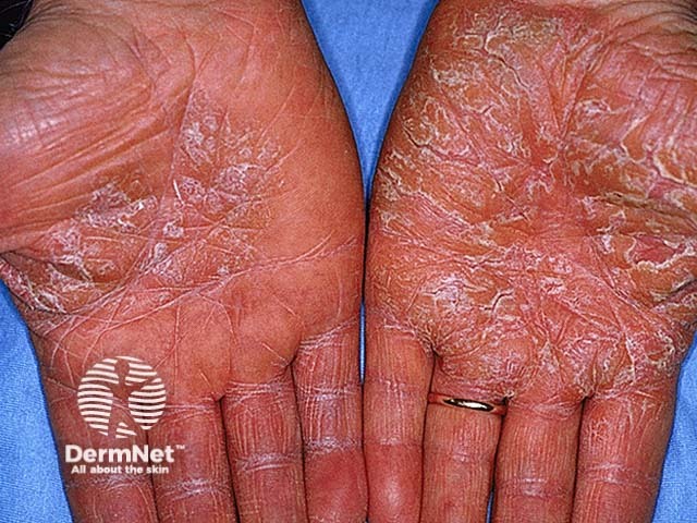 Hand dermatitis