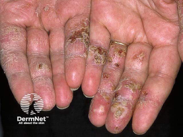 Hand dermatitis