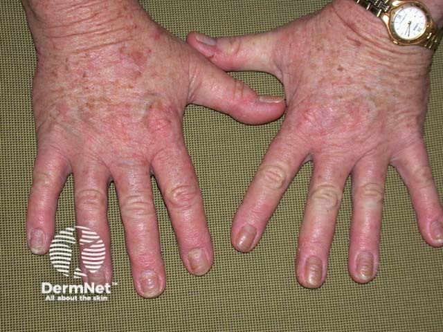 Hand dermatitis