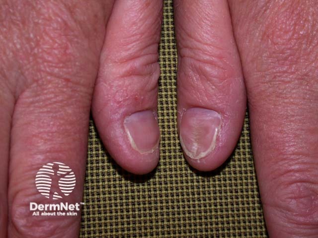 Hand dermatitis