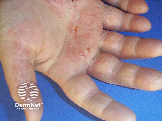 Hand dermatitis