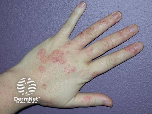 Hand dermatitis