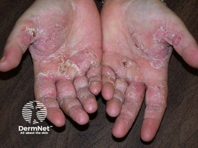 Hand dermatitis