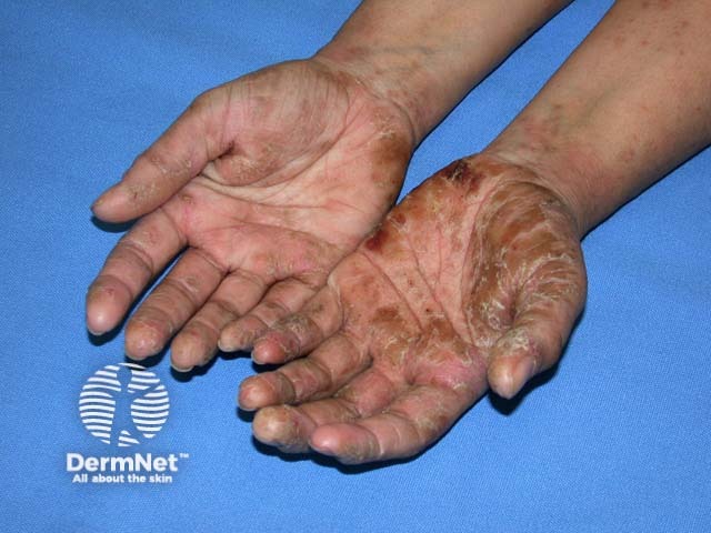 Hand dermatitis