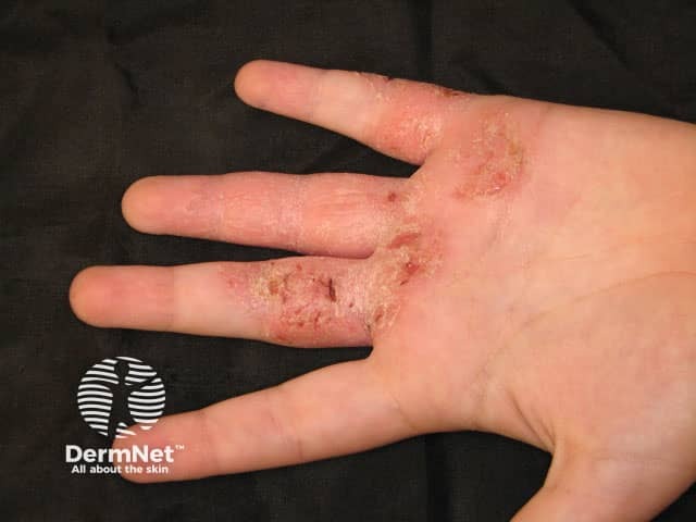 Hand dermatitis