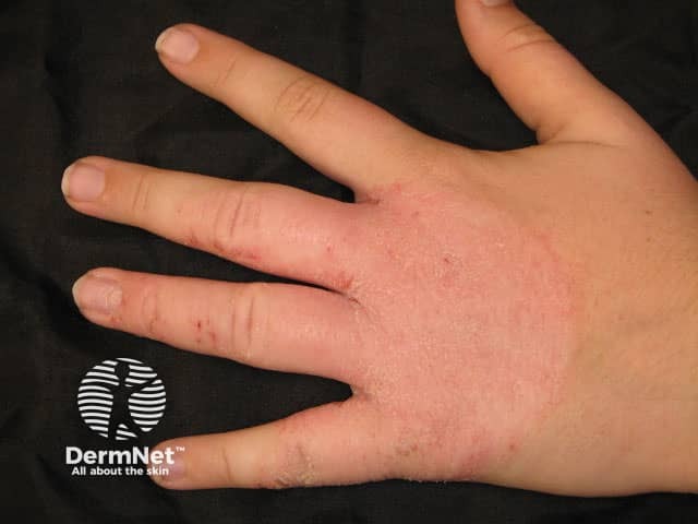 Hand dermatitis