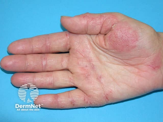 Hand dermatitis