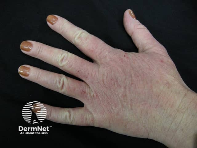 Hand dermatitis