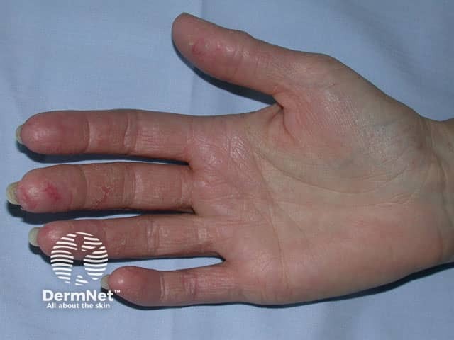 Hand dermatitis