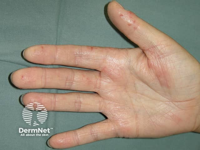 Hand dermatitis