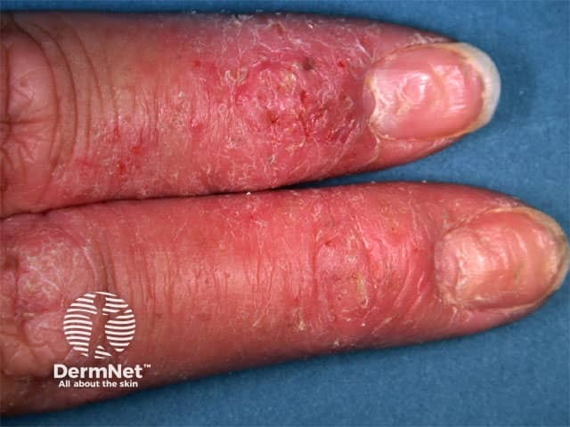 Hand dermatitis