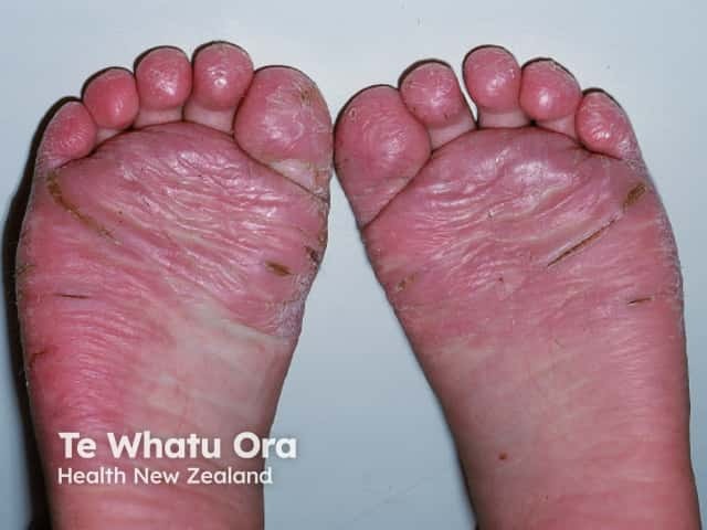 Juvenile plantar dermatosis