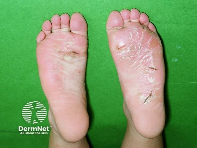 Juvenile plantar dermatosis