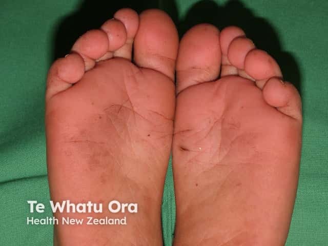 Juvenile plantar dermatosis