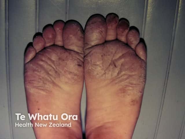 Juvenile plantar dermatosis