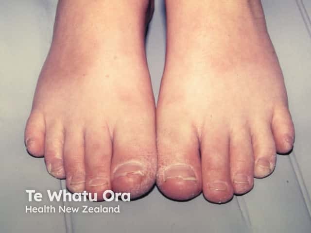 Juvenile plantar dermatosis