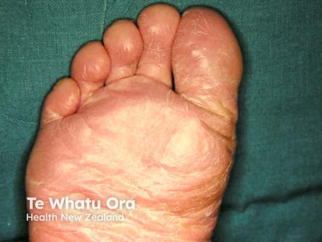 Juvenile plantar dermatosis