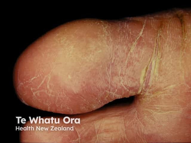 Juvenile plantar dermatosis