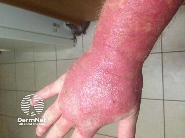 Contact dermatitis due to methylisothiazolinone