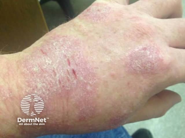 Contact dermatitis due to methylisothiazolinone