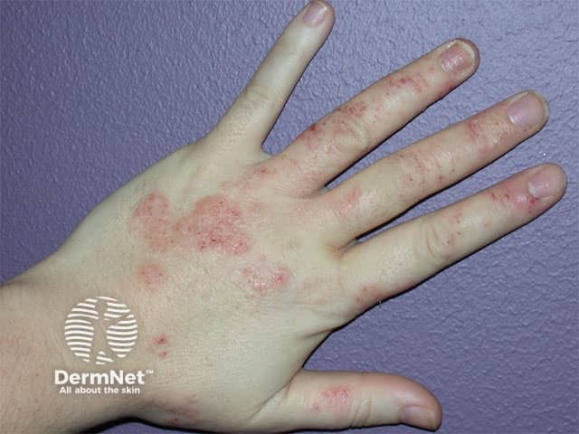 Hand dermatitis