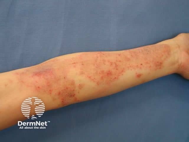 Discoid eczema