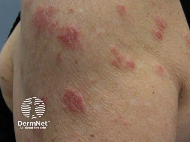 Nummular dermatitis