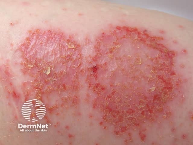 Discoid eczema