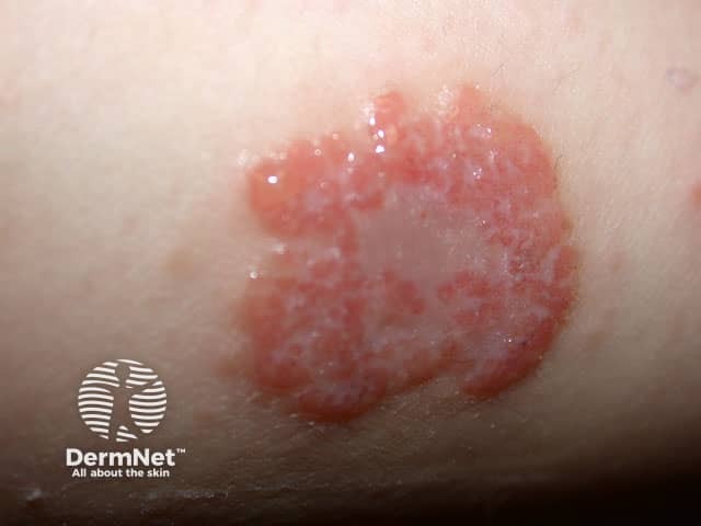 Discoid eczema