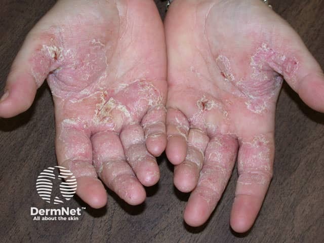 Palmar dermatitis