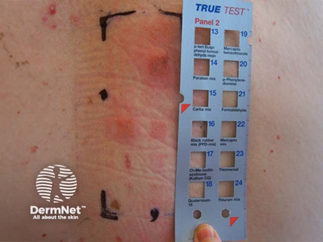 Patch test