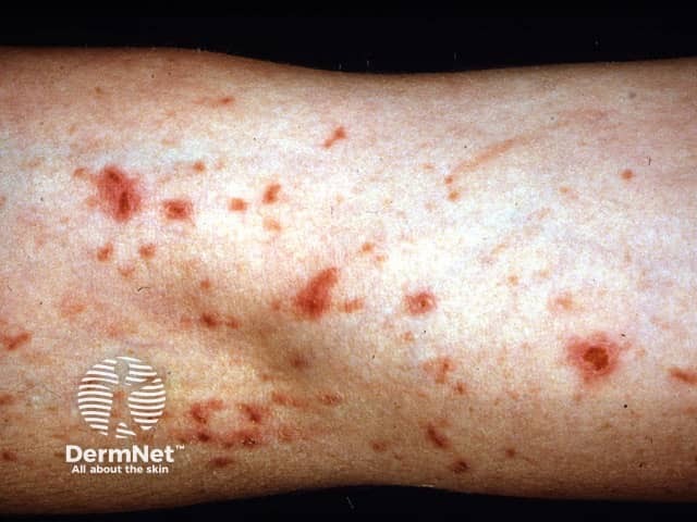 String trimmers dermatitis